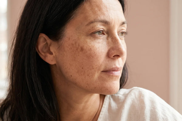 Gros plan sur le visage d'une femme avec des taches pigmentaires sur la pommette et la tempe